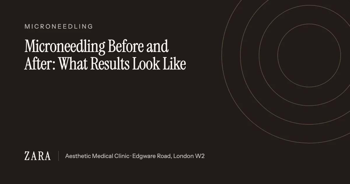 Title card reading: Microneedling Before and After: What Results Look Like
