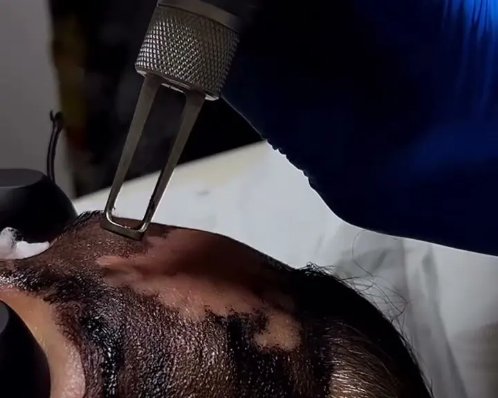 Practitioner in blue gloves passing a laser handpiece over a carbon-coated forehead