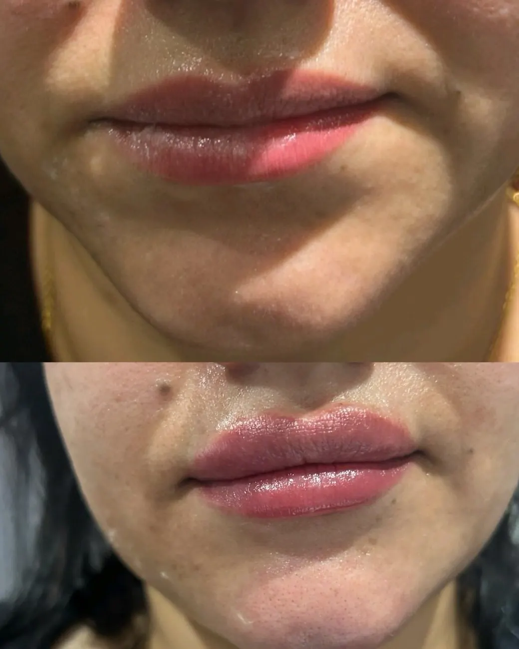 Half a millilitre of chin filler at ZARA: lower face before (top) and after (bottom)