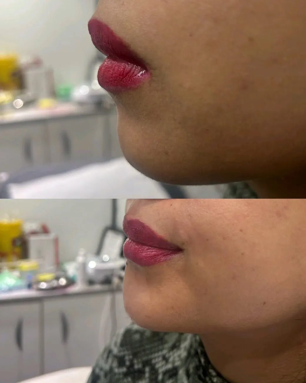 Chin filler at ZARA: side profile of the chin before (top) and after (bottom)