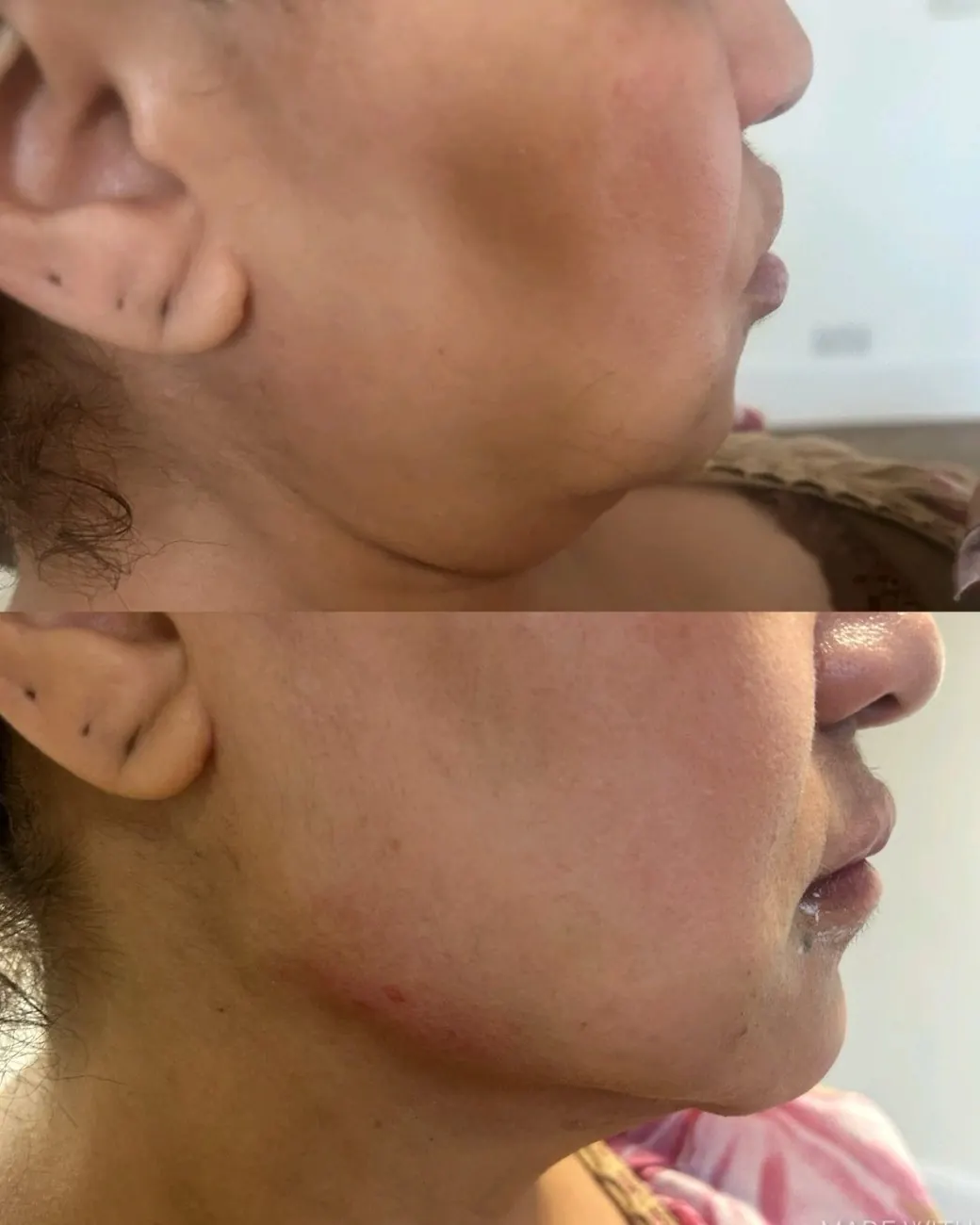 Jawline filler at ZARA: side view of the jaw before (top) and after (bottom)