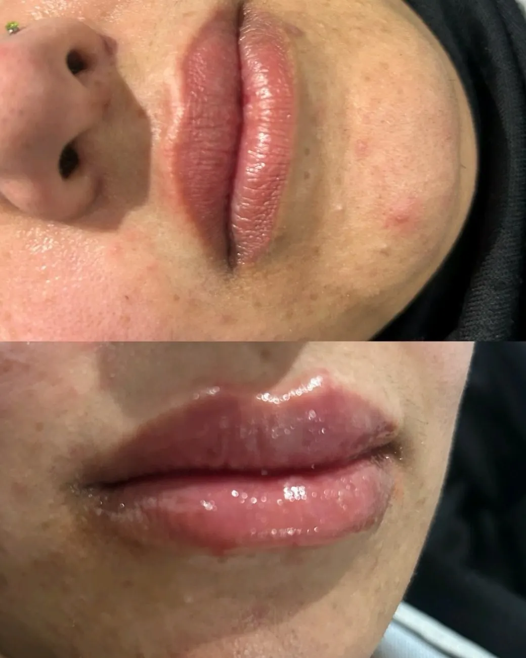Lip filler at ZARA: side view of lips before (top) and after (bottom)