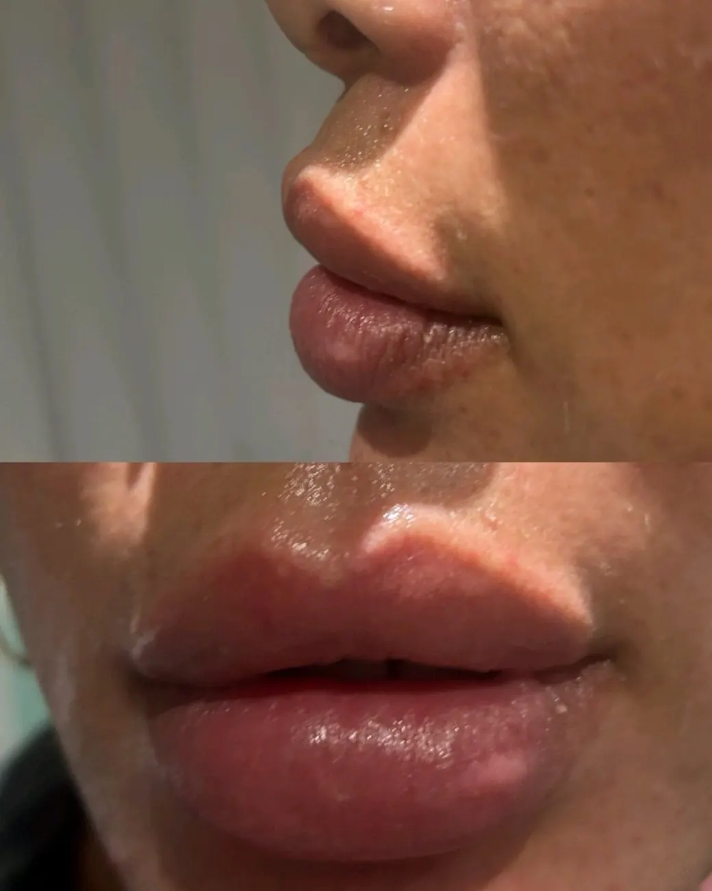 Lip filler at ZARA: profile of the lips before (top) and after (bottom)