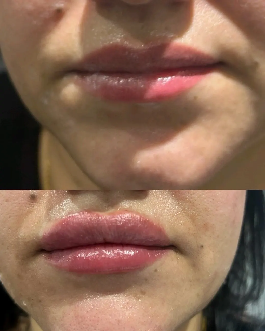 Lip filler at ZARA: front view of the lips before (top) and after (bottom)
