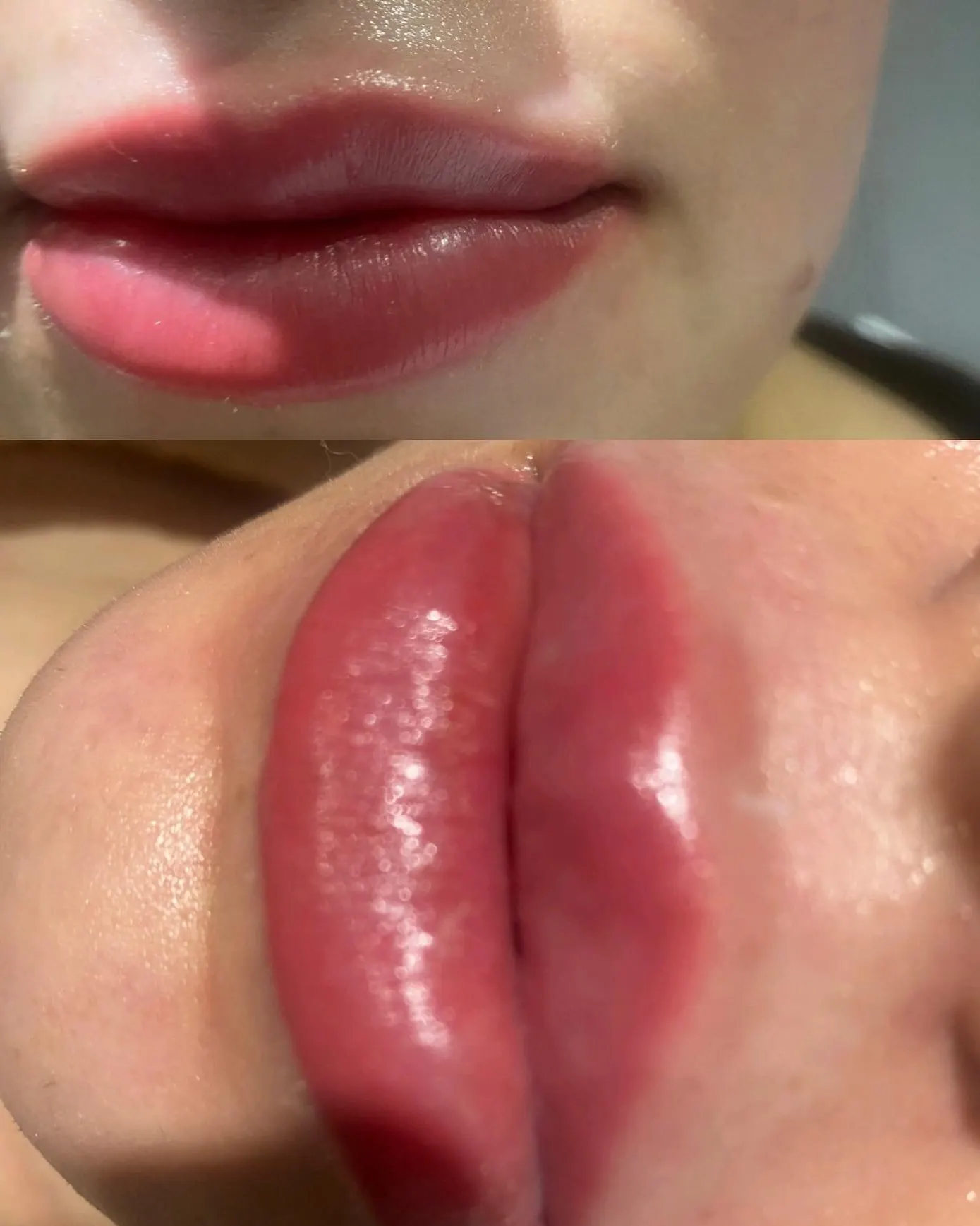 Lip filler at ZARA: lips before (top) and after (bottom)