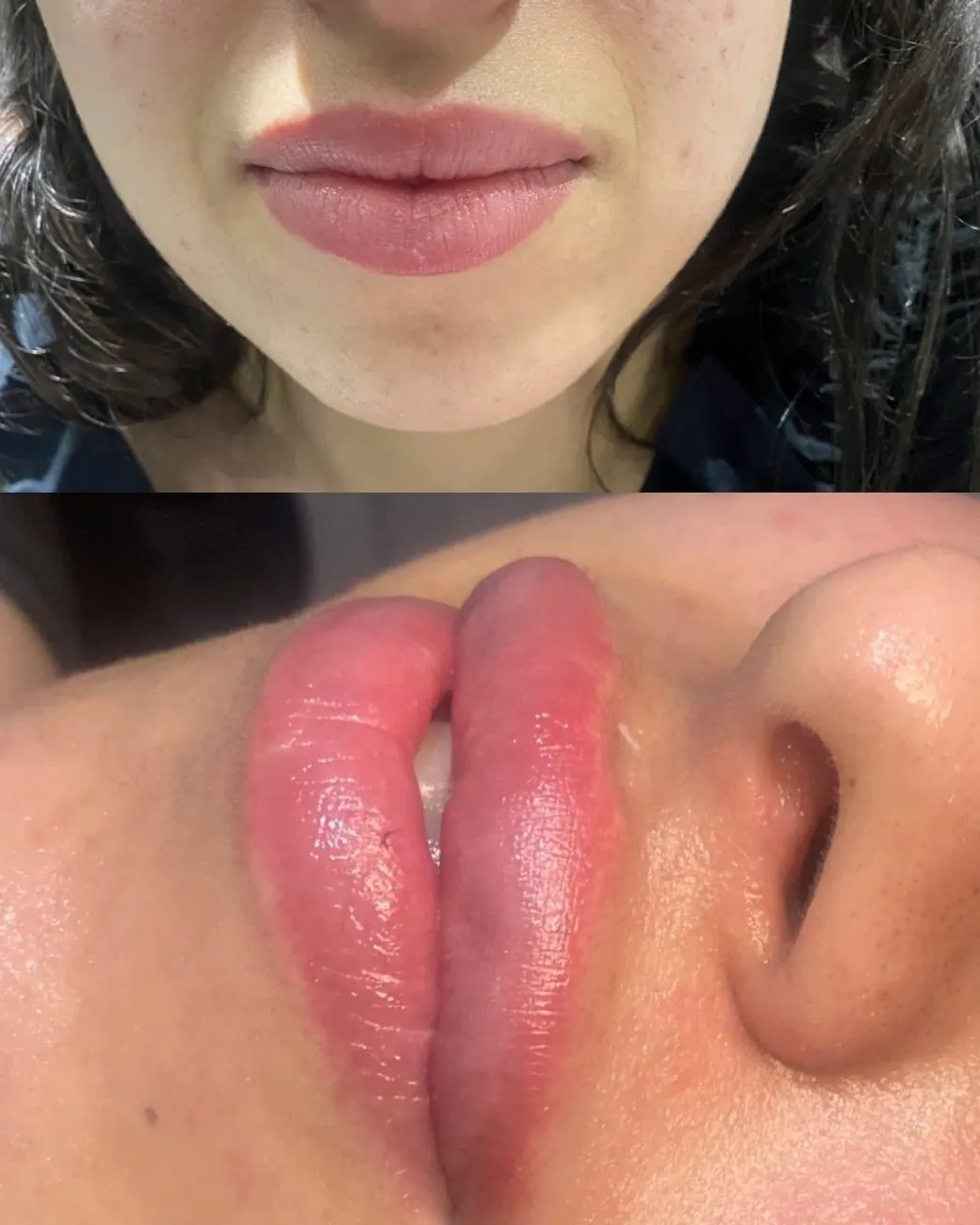 Lip filler at ZARA: lips before (top) and a side view after treatment (bottom)