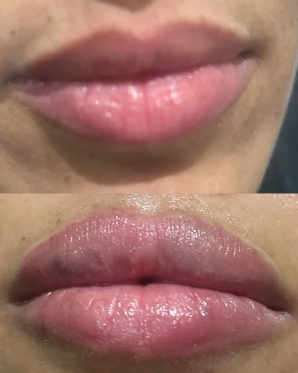 Lip filler at ZARA: lips before treatment (top) and fuller, defined lips after (bottom)