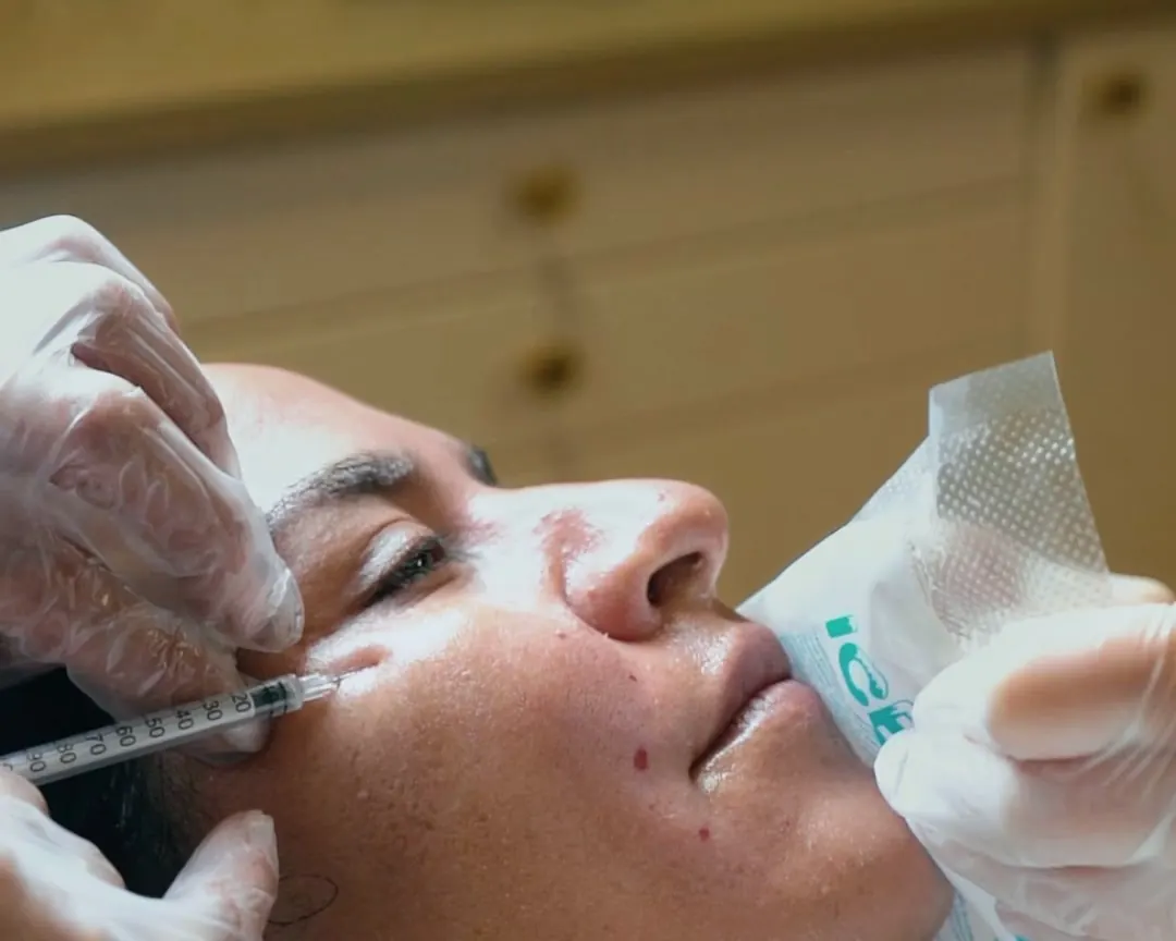 Practitioner giving a fine-needle skin injection beside the eye