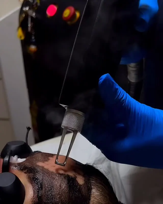 Laser handpiece passing over a carbon-coated forehead during a skin treatment at ZARA