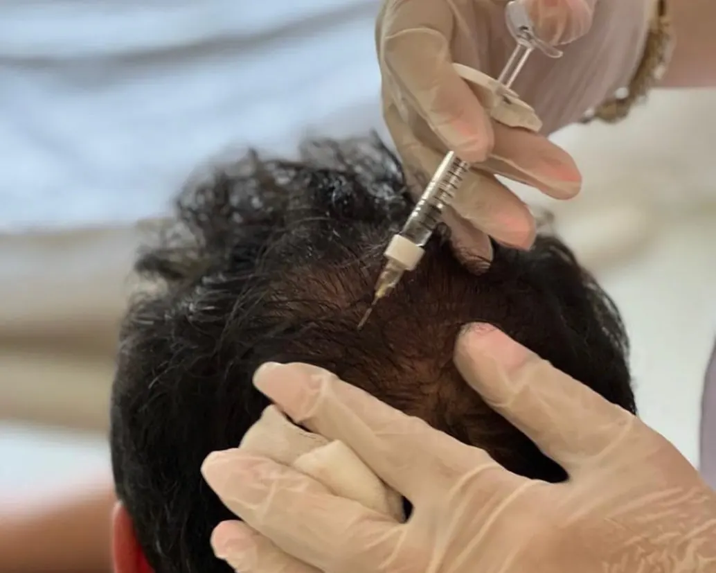 Gloved practitioner giving PRP injections into a client's scalp