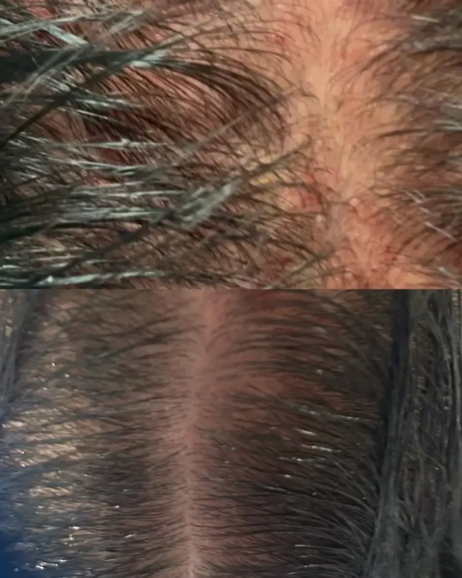 PRP hair treatment at ZARA: scalp before (top) and after three sessions (bottom)