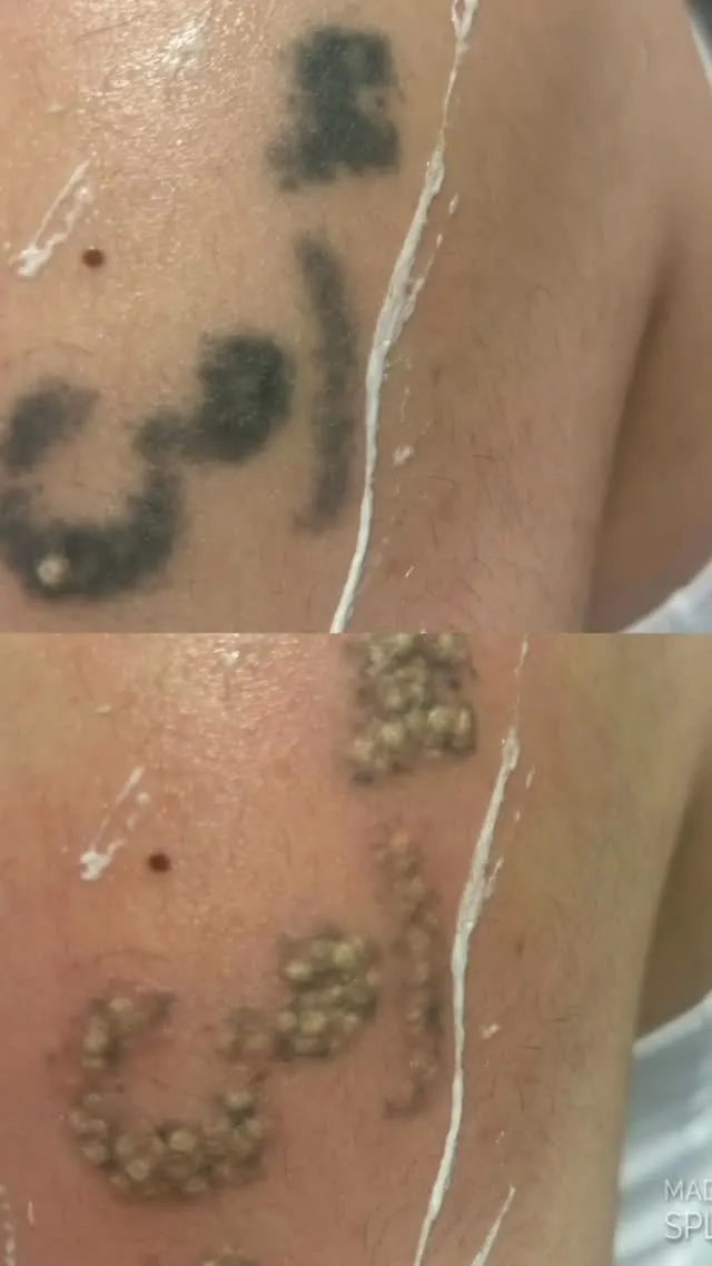 Tattoo removal at ZARA: a dark tattoo before treatment (top) and the frosted, raised skin straight after a laser session (bottom)