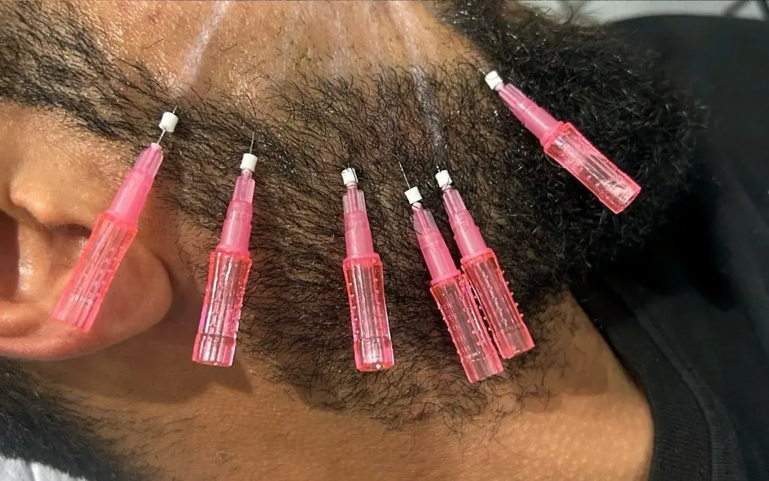 Mono threads being placed along the jaw and cheek during a thread lift